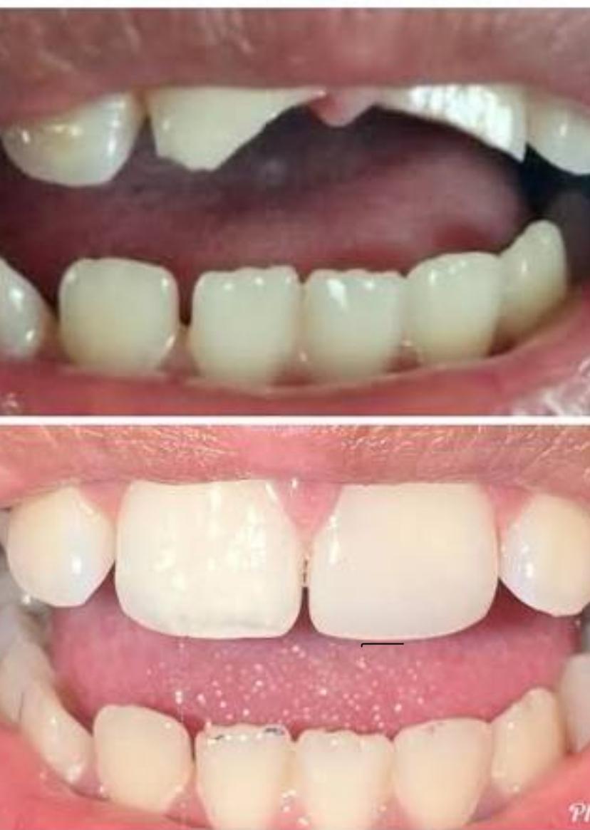 Antes e depois real de trauma dentário restaurado no consultório